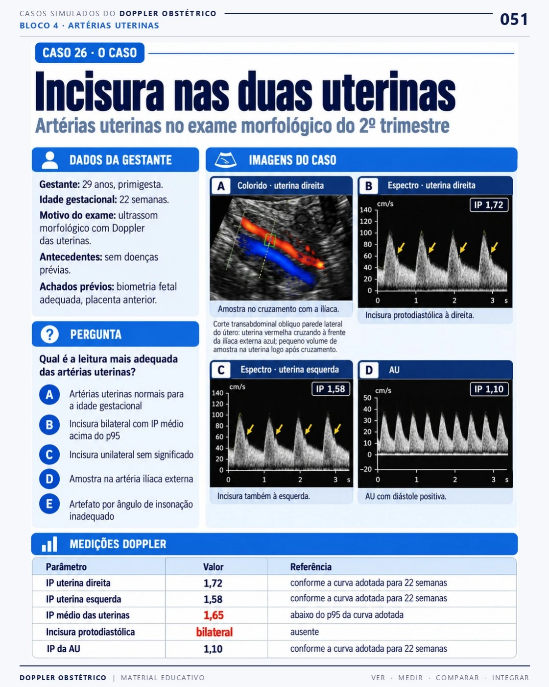 Página 51: Caso 26: incisura nas duas uterinas. Trecho do PDF de Doppler Obstétrico e Fetal.
